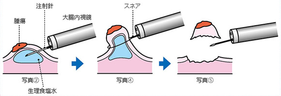 EMR（内視鏡的結腸ポリープ・粘膜切除術）