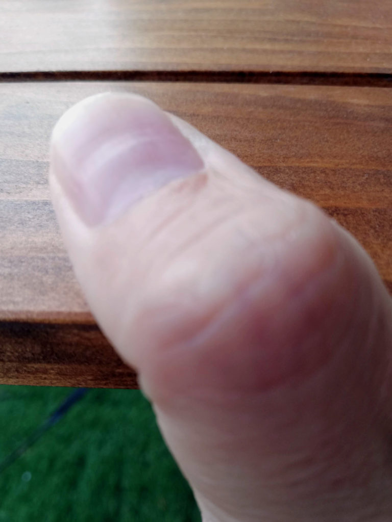 私の凹んでしまった親指の爪