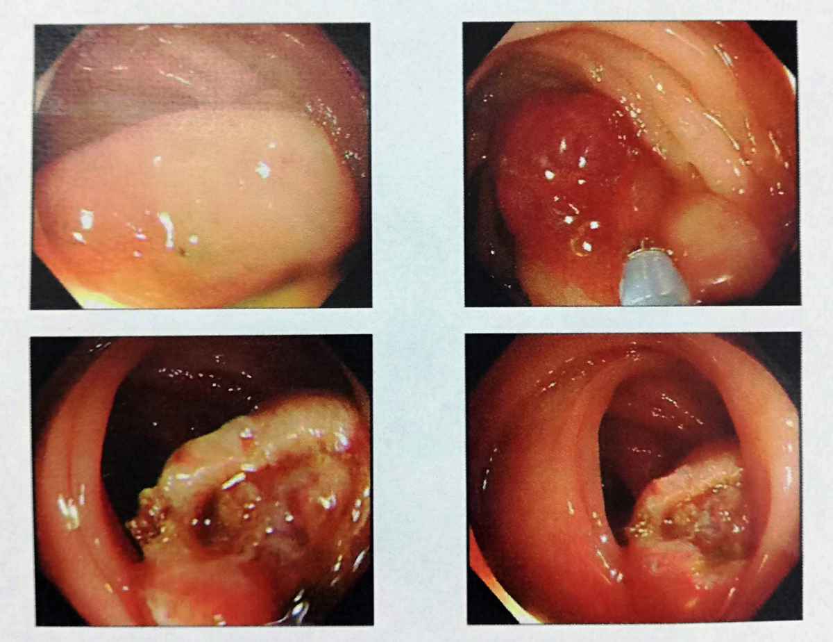 EMR（内視鏡的結腸ポリープ・粘膜切除術）ポリープ切除後の画像1