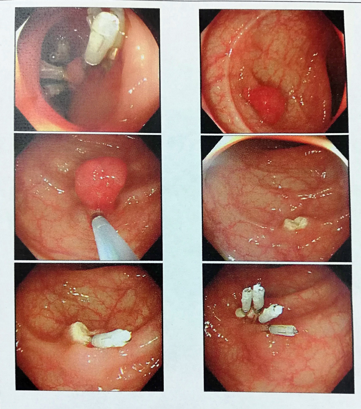 EMR（内視鏡的結腸ポリープ・粘膜切除術）ポリープ切除後の画像2