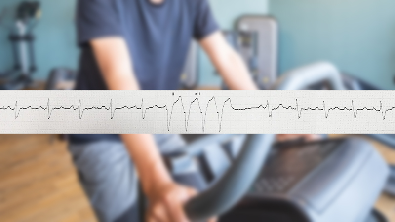 心リハ中に不整脈（期外収縮？）になる