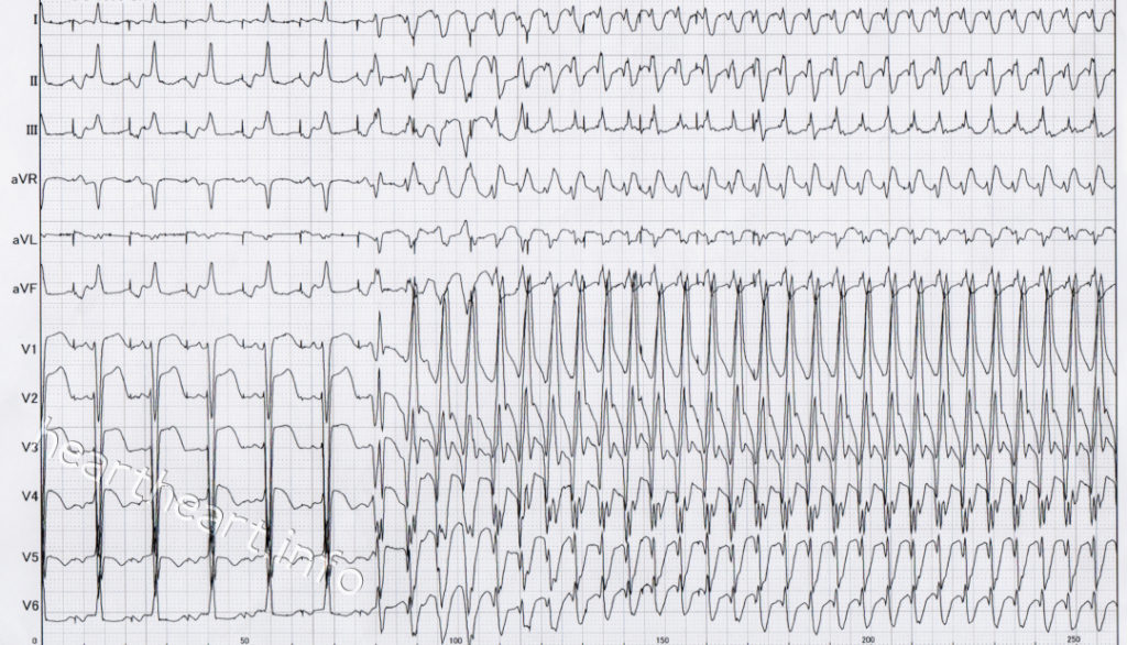 心室細動になったときの心電図の画像データ